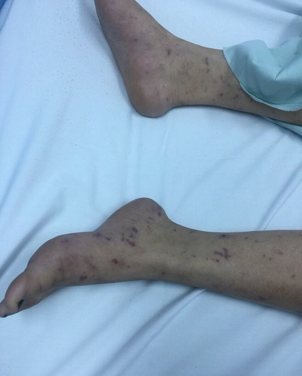 Thieu nu Ha Noi 15 tuoi bi vi khuan “an” nao, 14 nguoi khac bi cach ly