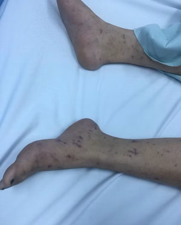 Thieu nu Ha Noi 15 tuoi bi vi khuan “an” nao, 14 nguoi khac bi cach ly