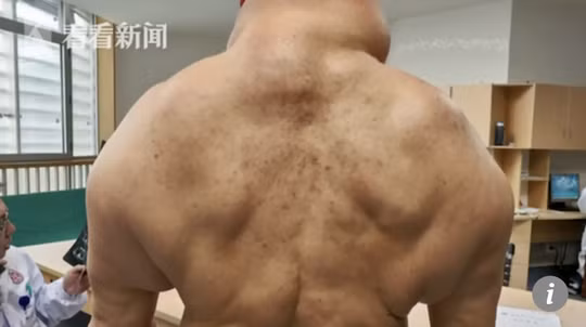 Phần vai lưng trông như những quái vật trong điện ảnh của người đàn ông Trung Quốc - Ảnh: SCMP.