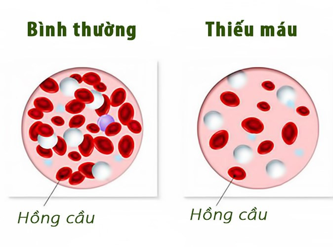 Nguy cơ thiếu máu: Bất kể là hình thức phẫu thuật nào, bạn có thể phải đối mặt với tình trạng mất máu quá nhiều trong và sau phẫu thuật. Mất lượng máu lớn và đột ngột như vậy có thể khiến bạn bị thiếu máu.