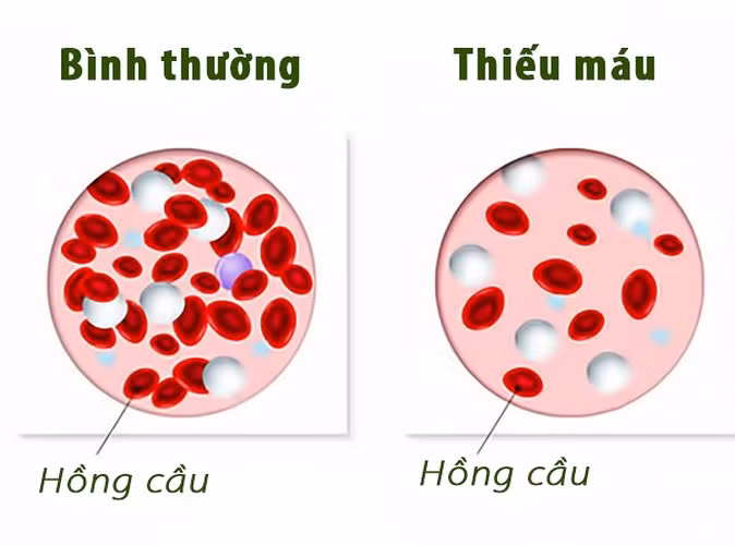 Nguy cơ thiếu máu: Bất kể là hình thức phẫu thuật nào, bạn có thể phải đối mặt với tình trạng mất máu quá nhiều trong và sau phẫu thuật. Mất lượng máu lớn và đột ngột như vậy có thể khiến bạn bị thiếu máu.
