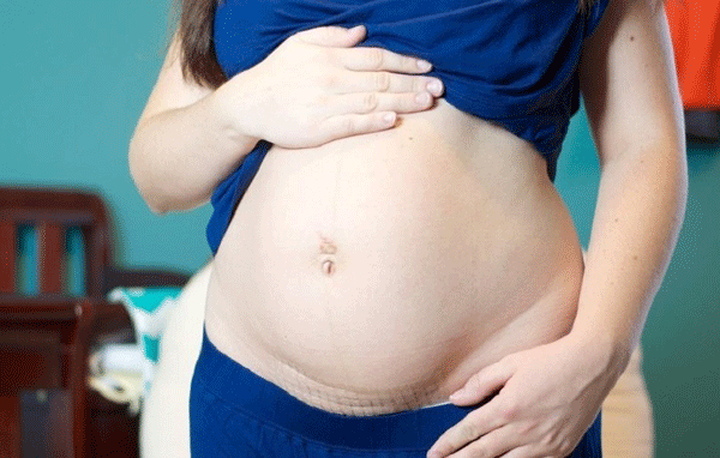 Nhiễm trùng: Bất kỳ vết thương phẫu thuật cũng có nguy cơ nhiễm trùng. Trong điều kiện được chăm sóc tốt, bệnh nhân vẫn luôn có nguy cơ nhiễm trùng từ vết mổ.