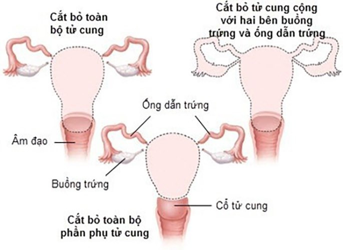 Thời gian phục hồi dài và để lại sẹo: Đây là loại tác dụng phụ thường thấy thi làm phẫu thuật cắt bỏ tử cung. Ở đây, vết rạch thường là theo chiều dọc, trong một số trường hợp hiếm hoi, vết cắt có thể theo chiều ngang. Thông qua vết cắt này, tử cung được lấy ra khỏi cơ thể. Phương pháp này đòi hỏi bạn phải nằm trên giường trong nhiều tuần sau khi phẫu thuật. Ngoài ra, sẹo từ vết rạch rất khó để hết.