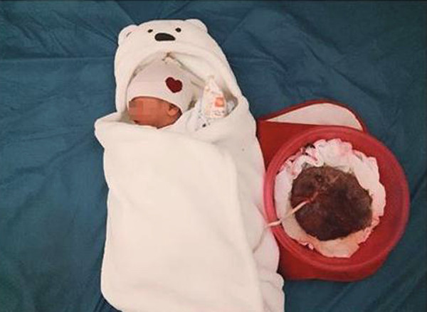 Hình ảnh bé sơ sinh tại Hưng Yên chào đời bằng phương pháp liên sinh gây nhiều tranh cãi.