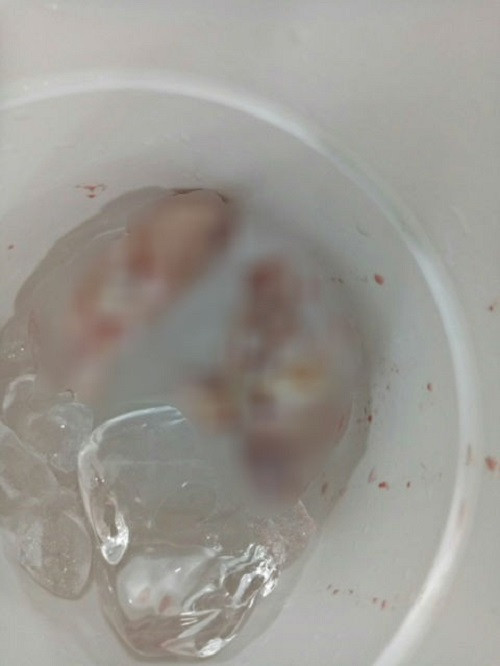 3 ngón tay được ngâm trong thùng đá lạnh. Ảnh: Người lao động.