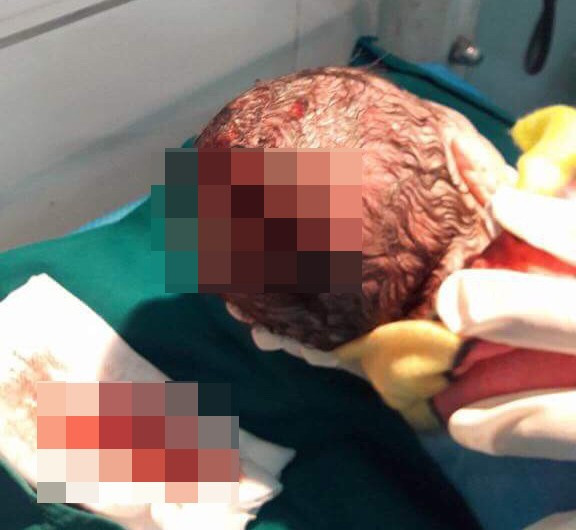 Vết thương trên đầu bé trai do mẹ tự sinh con ở nhà. (Ảnh: Bệnh viện cung cấp).