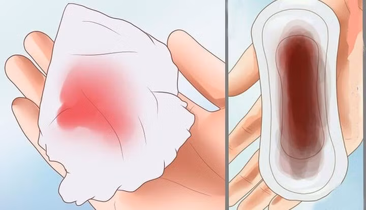 Chảy máu: Chảy máu là điều đầu tiên xảy ra khi bác sĩ bắt đầu thủ thuật phá thai. Nhưng số lượng chảy máu phụ thuộc hoàn toàn vào thời kỳ mang thai. Nếu mang thai trong mười tuần đầu tiên, chảy máu sẽ ít hơn.