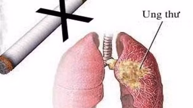  9. Khói Từ "khói" ở đây đầu tiên chính là chỉ thuốc lá, một trong những nhân tố gây tử vong do ung thư phổi hàng đầu trên thế giới. Thứ hai là khói bốc ra từ quá trình nấu nướng cũng có khả năng gây bệnh nếu không có biện pháp xử lý thích đáng. 