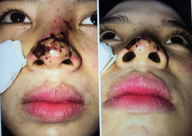 Sau làm đẹp tại spa, không ít các "Eva" hốt hoảng suy sụp khi nhìn thấy gương mặt mình trở nên biến dạng.