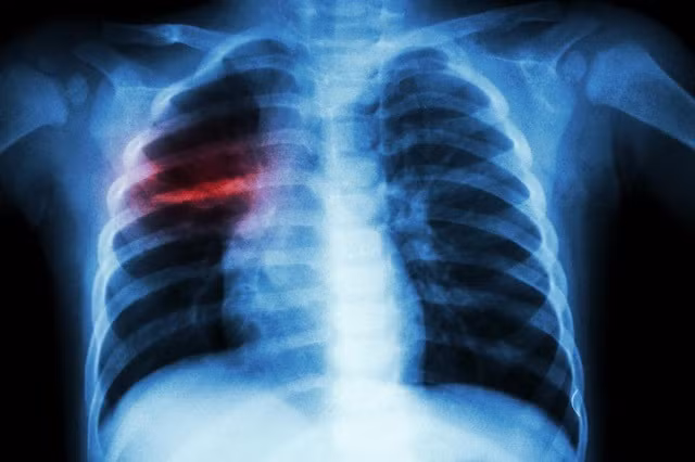 Một ca viêm phổi nặng do biến chứng của thủy đậu. Một ca viêm phổi nặng do biến chứng của thủy đậu.