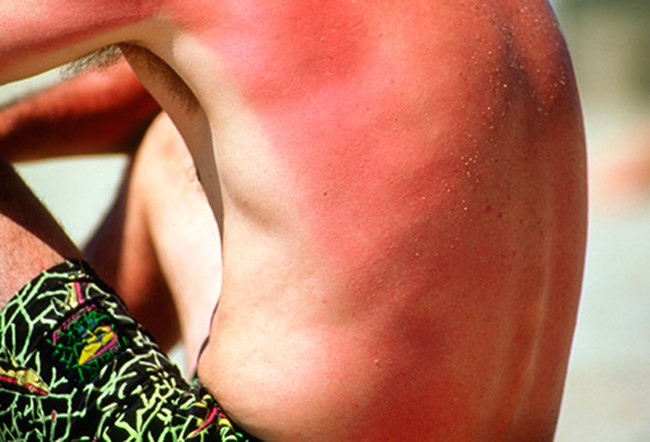 Cháy nắng: Da trần sẽ cháy nắng khi ở quá lâu ngoài trời. Da sẽ đỏ, ngứa, đau và nóng. Nghiêm trọng hơn, bạn có thể bị phồng rộp da, đau đầu, buồn nôn và sốt. Hãy uống thật nhiều nước, dùng nha đam để làm dịu và tuyệt đối không nặn chỗ phồng rộp.