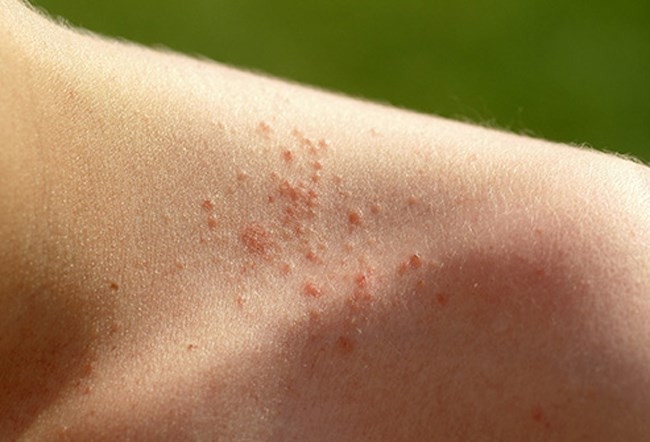 Phát ban nhiệt: Khi thời tiết nóng ẩm, bạn có thể đổ mồ hôi nhiều đến mức các tuyến mồ hôi bị tắc. Các lỗ chân lông không thể thoát nước sẽ khiến rôm sảy nổi lên. Bạn nên mặc trang phục rộng, sáng màu với chất liệu thấm mồ hôi để tránh tình trạng này.