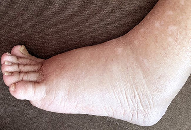 Phù nhiệt: Nhiệt độ cao có thể khiến ngón tay, ngón chân hoặc mắt cá chân sưng phù và da căng chặt. Tình trạng này thường không nghiêm trọng và sẽ tự thuyên giảm khi nhiệt độ giảm.