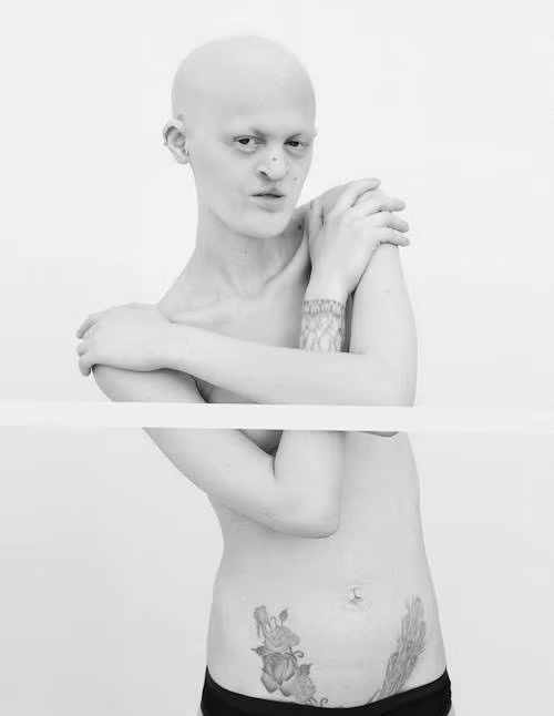 Ngoài ra, cô cũng bị môi hở và rụng tóc, làm cho sợi lông mọc ngược vào bên trong. Lông mi mọc ngược đã làm hỏng giác mạc của cô, khiến mắt cô không được tinh tường.