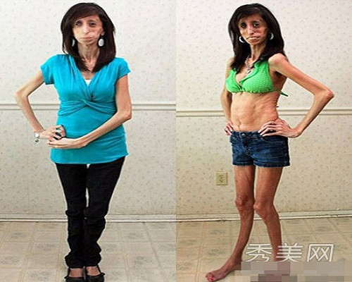 Năm 2013, cô được TED mời đến để tự thuật câu chuyện của mình. Cô tự quay câu chuyện của mình thành bộ phim tài liệu “Trái tim dũng cảm” (Brave Heart) để khuyến khích nhiều người hơn để lấy lại niềm tin, không bị tổn thương bởi những lời nhận xét ác ý.