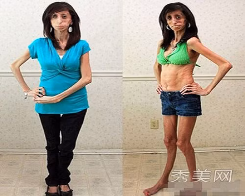 Năm 2013, cô được TED mời đến để tự thuật câu chuyện của mình. Cô tự quay câu chuyện của mình thành bộ phim tài liệu “Trái tim dũng cảm” (Brave Heart) để khuyến khích nhiều người hơn để lấy lại niềm tin, không bị tổn thương bởi những lời nhận xét ác ý.