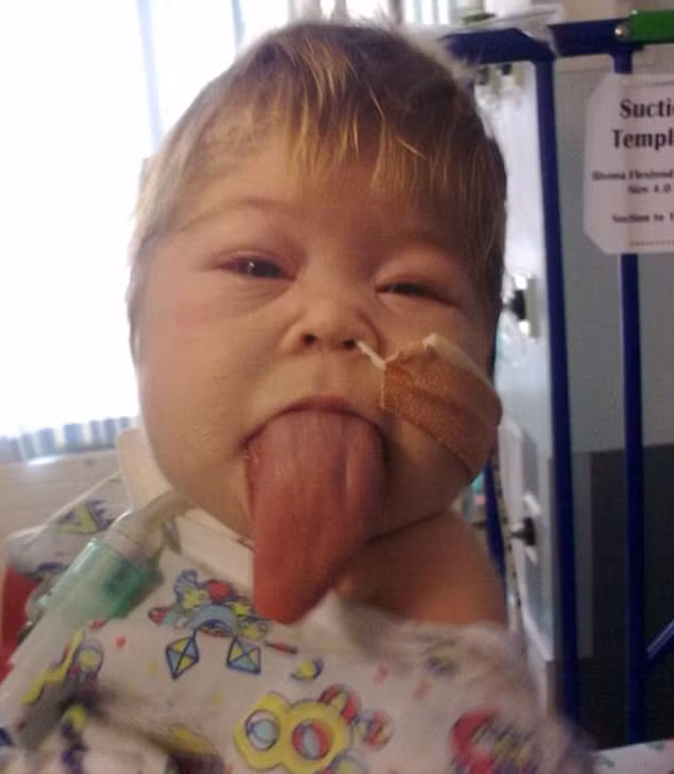 Bé gái với chiếc lưỡi to nhất thế giới. Bé gái Olivia Gillies 4 tuổi sinh ra với Hội chứng Beckwith-Wiedemann (BWS) hiếm gặp khiến lưỡi to và nội tạng liên tục lớn. Căn bệnh ma quái này xuất hiện ở Anh với tỉ lệ 1/15.000 trẻ em, gây ra bởi sự mấy cân bằng trong các gene chi phối tốc độ tăng trưởng. Biểu hiện của bệnh là thành bụng dày, lưỡi và chân tay to. Trong một số trường hợp, trẻ có thể bị điếc hoặc bệnh tim. Bố mẹ cô bé đã phát hiện chứng bệnh ngay từ khi siêu âm, nhưng bằng tình yêu thương vô bờ, họ đã quyết tâm sinh em bé. Olivia Gillies sắp trải qua cuộc đại phẫu thuật thứ tư kể từ khi sinh.