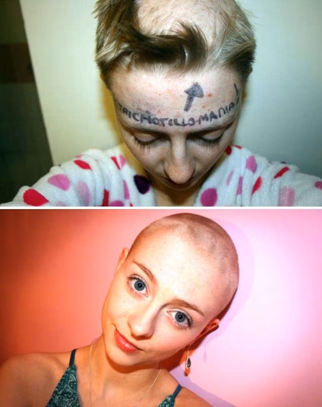 Cô gái nghiện “bứt tóc” mình. Cô bé Rhiannon người Anh bắt đầu có thói quen tự nhổ tóc mình từ năm 12 tuổi.Chính vì thế, tới nay, dù mới chỉ bước sang tuổi 17, cô đã có vài mảng da đầu bị hói. Đây là hậu quả của hội chứng nghiện tự nhổ lông, tóc có tên Trichotillomania. Người mắc hội chứng này luôn bị thôi thúc giật tóc hay lông mày, lông mi của bản thân khi chán nản hoặc thiếu tự tin. 