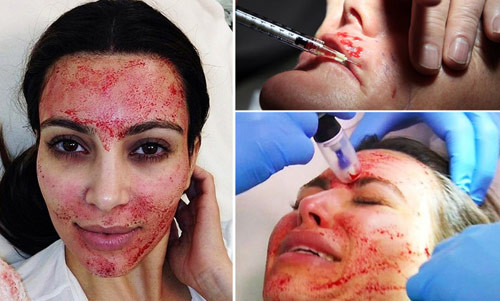 Làm đẹp da bằng máu tươi. Ban đầu, người ta chích máu từ cánh tay của bạn, sau đó đưa chúng vào máy ly tâm để trích xuất phần huyết tương giàu tiểu cầu nhất. Sau đó, họ bơm trực tiếp dung dịch vào da mặt bằng những cây kim nhỏ.