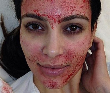 Một số mỹ nhân Hollywood như Kim Kardashian, Victoria Beckham hay Gisele Bundchen từng thử nghiệm phương pháp làm đẹp rùng rợn này