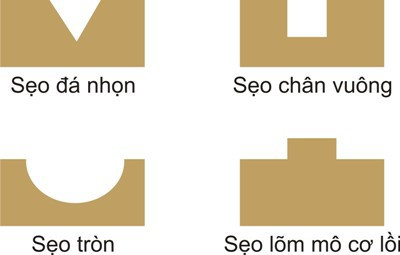 Mụn là kẻ thù của tất cả chị em phụ nữ nhưng những tàn tích mà mụn để lại còn dai dẳng và khó xử lý hơn nhiều nếu bạn không hiểu bản chất của nó. Điều cần thiết nhất khi có mụn là tìm hiểu xem nó thuộc loại nào để tìm cách xóa sẹo hiệu quả nhất.