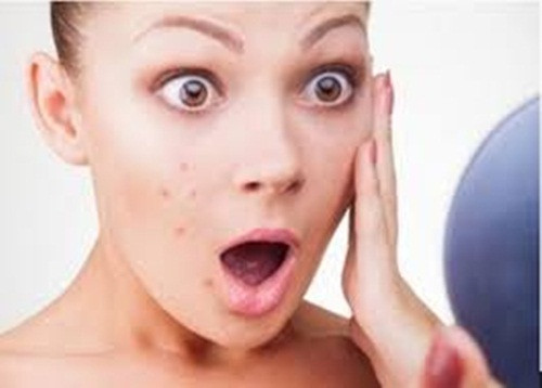 Sẹo lõm tròn. Cách nhanh nhất để chấm dứt loại sẹo này là tiêm filler dưới bề mặt da. Có thể chỉ cần qua 1 lần tiêm sẽ hiệu quả. Những phương pháp khác để trị sẹo này có thể là lột da hóa học và Microdermabrasion (phương pháp trị liệu mài mòn da) để loại bỏ lớp da ngoài cùng giúp làm mờ vết tích sẹo lõm.