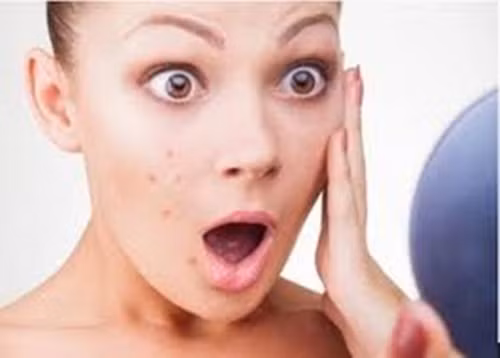 Sẹo lõm tròn. Cách nhanh nhất để chấm dứt loại sẹo này là tiêm filler dưới bề mặt da. Có thể chỉ cần qua 1 lần tiêm sẽ hiệu quả. Những phương pháp khác để trị sẹo này có thể là lột da hóa học và Microdermabrasion (phương pháp trị liệu mài mòn da) để loại bỏ lớp da ngoài cùng giúp làm mờ vết tích sẹo lõm.