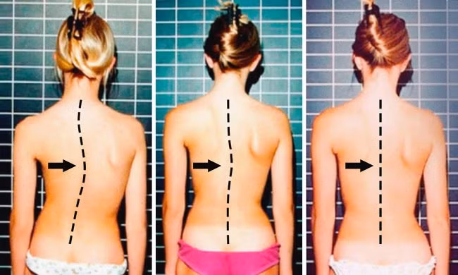 Trong thời đại công việc văn phòng khiến chúng ta ngồi quá nhiều và lối sống ít vận động khiến đau lưng là vấn đề phổ biến thì bạn nên thực hiện những bài tập cột sống khỏe mạnh sau. Chắc chắn, chỉ cần 3 tuần lưng bạn sẽ dẻo dai hơn.