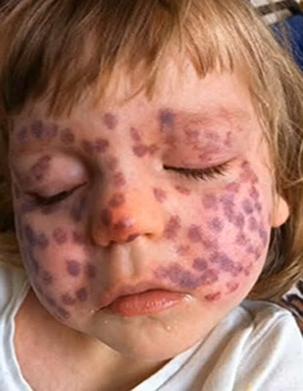 Khi vừa sinh ra, Matilda đã có những vết chàm trên mặt. Lúc đầu, các bác sỹ nghĩ rằng đó chỉ là những vết bầm tím. Tuy nhiên, khoảng 2 tuần sau đó, Matilda được chẩn đoán mắc hội chứng Sturge Weber, đây là một dạng rối loạn thần kinh da hiếm gặp.