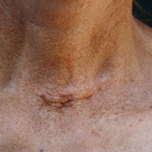 Bệnh tuyến giáp. Nếu thấy có vết sẹo hình mặt cười dưới cổ thì khả năng người đó đã phẫu thuật tuyến giáp. Theo Hiệp hội Tuyến giáp Mỹ, khoảng 12-13% phụ nữ bị ảnh hưởng bởi rối loạn tuyến giáp và họ có khả năng bị bệnh tật này cao gấp 7 lần nam giới.