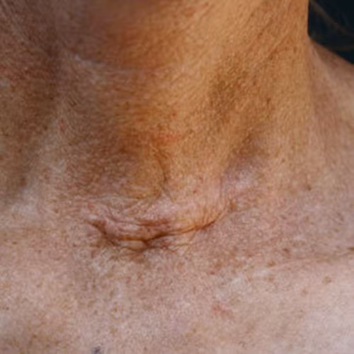 Bệnh tuyến giáp. Nếu thấy có vết sẹo hình mặt cười dưới cổ thì khả năng người đó đã phẫu thuật tuyến giáp. Theo Hiệp hội Tuyến giáp Mỹ, khoảng 12-13% phụ nữ bị ảnh hưởng bởi rối loạn tuyến giáp và họ có khả năng bị bệnh tật này cao gấp 7 lần nam giới.