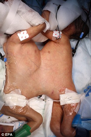 Hai bé song sinh dính liền sinh non 2 tháng trong tháng 12 vừa qua. Hai bé có phần gan và ngực dính liền nhau. Mỗi bé chỉ nặng hơn 1kg. Một em có quá nhiều máu và huyết áp cao trong khi bé còn lại huyết áp quá thấp.