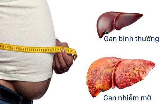 Bên cạnh hút thuốc lá, bệnh gan nhiễm mỡ cũng là một nguyên nhân khác dẫn đến xơ gan. Ảnh: momautang.