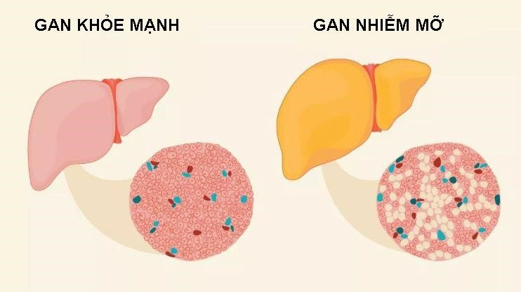 Tuy nhiên, 20% bệnh gan nhiễm mỡ có thể diễn tiến đến xơ gan. Ảnh: momautang.