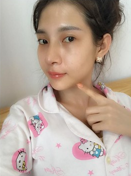 Theo chia sẻ của Kim (nickname Kim Nhí), dù rất đau đớn nhưng hễ nghĩ đến thành quả sau khi phẫu thuật, có được một dung mạo khác, xinh đẹp hơn hẳn là cô lại cảm thấy có động lực, tiếp tục chịu đau làm phẫu thuật.