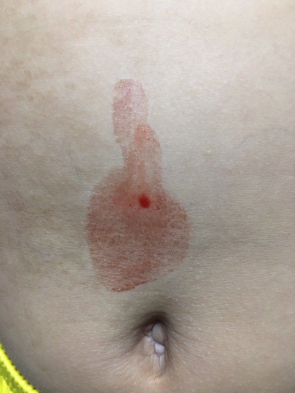 TP HCM phát hiện một trường hợp bị “mồ hôi máu” TP HCM phat hien mot truong hop bi “mo hoi mau”