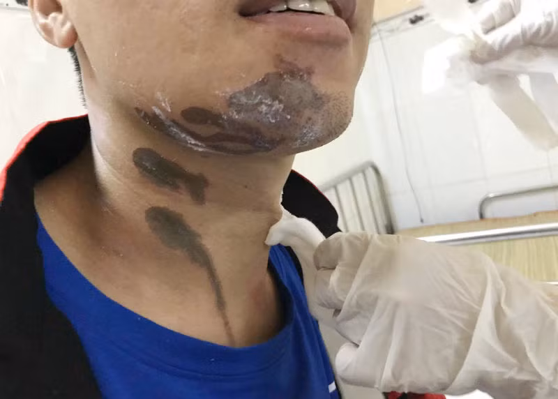 Bong nang khi bi hoa chat tay rua bon cau vang trung