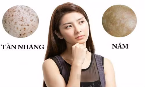 Cach tri khoi tan nhang, nam da vinh vien chi bang 1 lat ca tim re tien