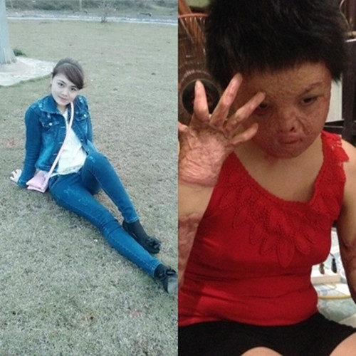 Chị Dung trước (trái) và sau (phải) khi bị người chồng ác tâm tưới xăng đốt.