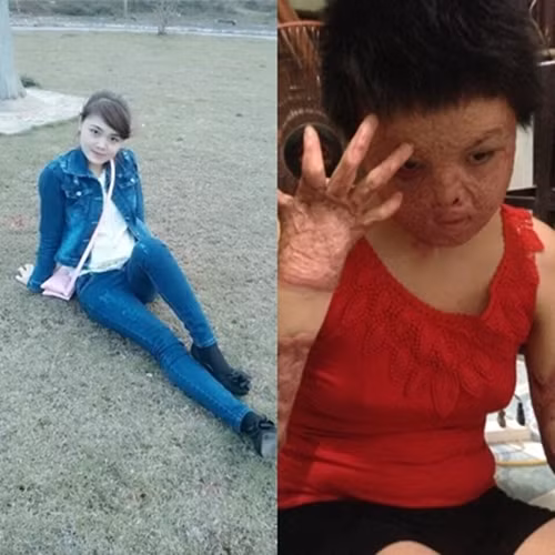 Chị Dung trước (trái) và sau (phải) khi bị người chồng ác tâm tưới xăng đốt.