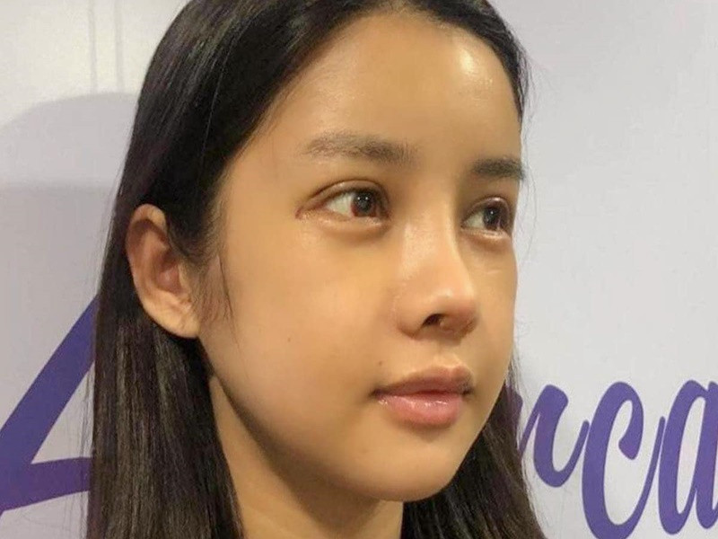 Gương mặt của Trình Mỹ Duyên bớt sưng sau 7 ngày phẫu thuật thẩm mỹ.