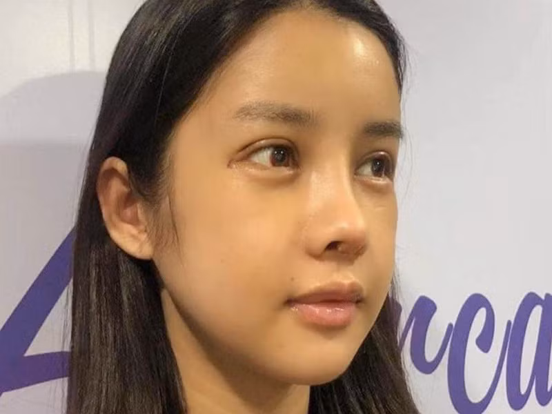 Gương mặt của Trình Mỹ Duyên bớt sưng sau 7 ngày phẫu thuật thẩm mỹ.