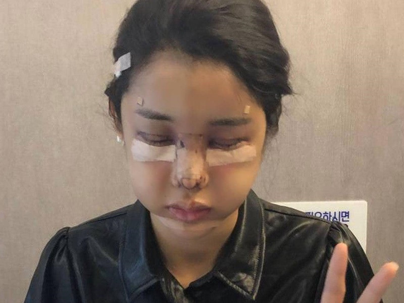 Trình Mỹ Duyên hạ gò má, gọt hàm, trượt cằm, cấy mỡ tự thân, cắt mí mắt, hạ góc đuôi mắt, sửa mũi... Trong ảnh, nữ diễn viên sau 3 ngày dao kéo.