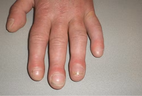 Phoi hu, co the hien ro 3 dau hieu nay-Hinh-3