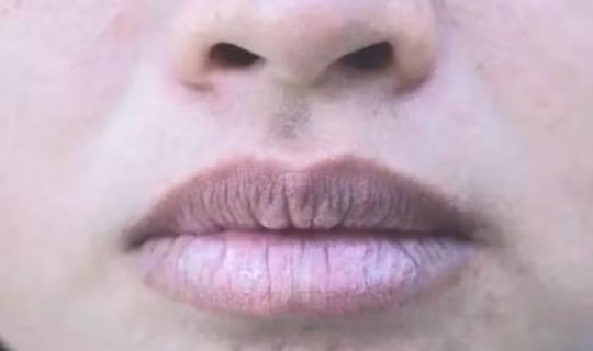 Phoi hu, co the hien ro 3 dau hieu nay