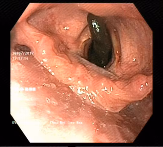 Vat dai 10 cm ngo nguay trong khi quan benh nhan