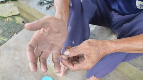 Tan mat nguoi dan ong co 25 ngon tay, chan o Dong Thap