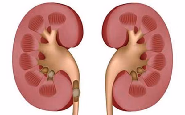 Để bệnh không nặng lên, những người bị sỏi thận nếu lỡ ăn những thực phẩm giàu oxalat, nên tăng cường uống nước để thúc đẩy đào thải chất này.