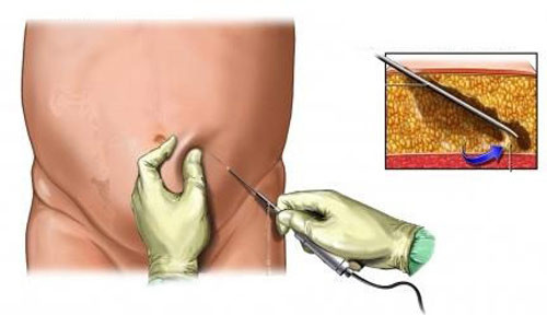 6. Thuyên tắc mạch phổi. Quá trình hút mỡ có thể khiến những mạch máu nhỏ bị vỡ và tạo ra những giọt váng mỡ. Đôi khi, tế bào mỡ chui vào lòng tĩnh mạch, chạy về tim và phổi, gặp hàng rào mao mạch phổi bị tắc lại, gây thuyên tắc mạch máu phổi. Biến chứng này gây suy hô hấp, khó thở, thậm chí tử vong nếu không kịp thời chữa trị.