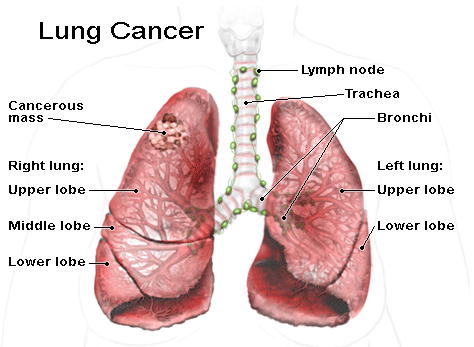 Tỷ lệ 80-90% mắc căn bệnh này là do tiếp xúc với khói thuốc lá lâu dài, và 10-15% là do do ô nhiễm không khí bao gồm cả hút thuốc thụ động, khí radon, asbestos và các yếu tố di truyền .